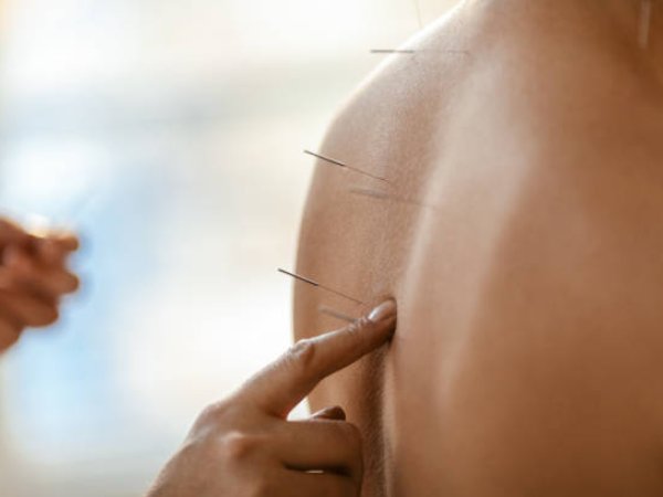 Acupuncture needles being applied to a patient's back